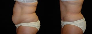 Before and after Tummy Tuck case 32712 - Angle 3