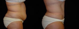 Before and after Tummy Tuck case 32712 - Angle 4