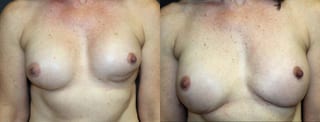 Before and after Breast Revision case 32713 - Angle 1