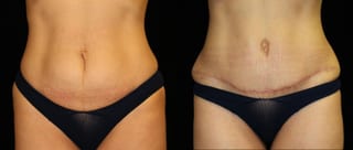Before and after Tummy Tuck case 32715 - Angle 1