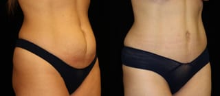 Before and after Tummy Tuck case 32715 - Angle 2