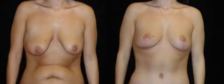 Before and after Breast Lift case 32719 - Angle 1
