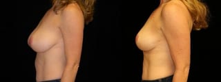 Before and after Breast Lift case 32720 - Angle 2