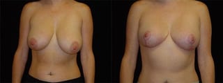 Before and after Breast Lift case 32721 - Angle 1