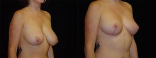 Before and after Breast Lift case 32721 - Angle 2