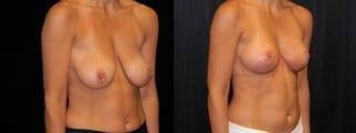 Before and after Breast Lift case 32722 - Angle 2