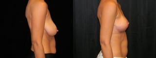 Before and after Breast Lift case 32722 - Angle 3