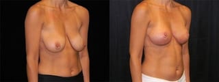 Before and after Breast Lift case 32723 - Angle 2