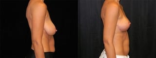 Before and after Breast Lift case 32723 - Angle 3