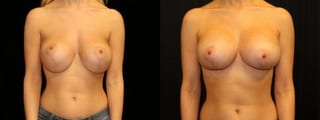 Before and after Breast Revision case 32724 - Angle 1
