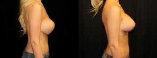 Before and after Breast Revision case 32724 - Angle 3
