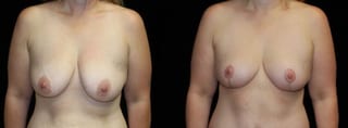 Before and after Breast Lift case 32725 - Angle 1