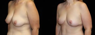 Before and after Breast Lift case 32725 - Angle 2