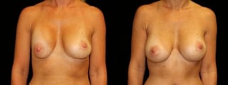 Before and after Breast Revision case 32726 - Angle 1