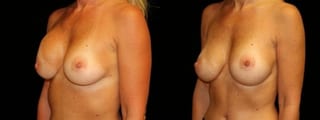 Before and after Breast Revision case 32726 - Angle 2