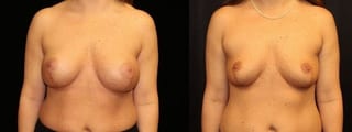 Before and after Breast Revision case 32727 - Angle 1