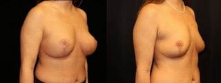 Before and after Breast Revision case 32727 - Angle 2