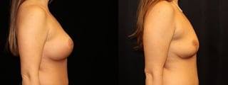 Before and after Breast Revision case 32727 - Angle 3