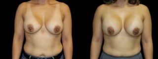 Before and after Breast Revision case 32728 - Angle 1