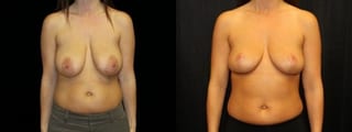 Before and after Breast Lift case 32729 - Angle 1