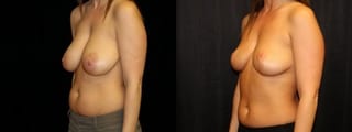 Before and after Breast Lift case 32729 - Angle 2
