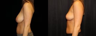 Before and after Breast Lift case 32729 - Angle 3