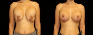 Before and after Breast Revision case 32731 - Angle 1