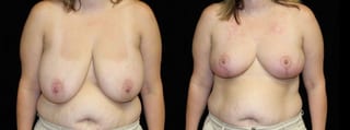 Before and after Breast Lift case 32732 - Angle 1