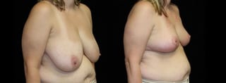 Before and after Breast Lift case 32732 - Angle 2