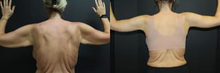 Before and after Arm Lift case 32733 - Angle 2