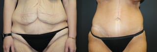 Before and after Tummy Tuck case 32735 - Angle 1