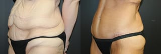 Before and after Tummy Tuck case 32735 - Angle 2