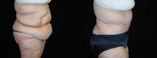 Before and after After Weight Loss case 32740 - Angle 2