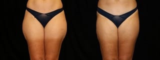 Before and after Liposuction case 32741 - Angle 1