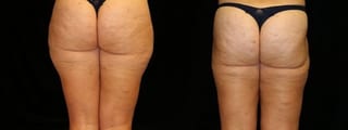 Before and after Liposuction case 32741 - Angle 2
