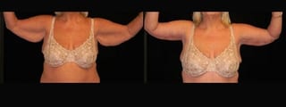 Before and after Arm Lift case 32742 - Angle 1