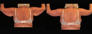 Before and after Arm Lift case 32742 - Angle 2