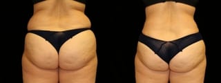 Before and after Liposuction case 32743 - Angle 1