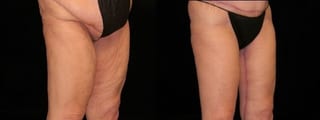 Before and after Thigh Lift case 32744 - Angle 1