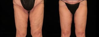 Before and after Thigh Lift case 32744 - Angle 2