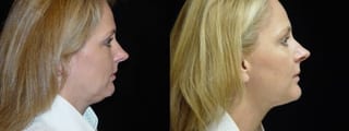 Before and after Liposuction of the Neck case 32745 - Angle 2