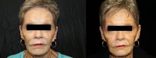 Before and after Sculptra® case 32746 - Angle 1