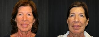 Before and after Sculptra® case 32748 - Angle 1