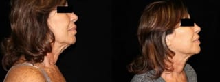 Before and after Sculptra® case 32748 - Angle 2