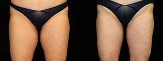 Before and after Liposuction case 32747 - Angle 1