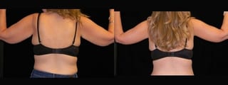 Before and after Arm Lift case 32749 - Angle 2