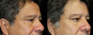 Before and after Blepharoplasty case 32750 - Angle 1