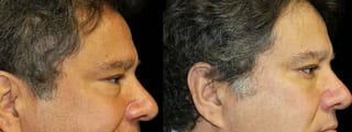 Before and after Blepharoplasty case 32750 - Angle 2