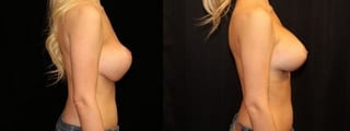Before and after Breast Revision case 32751 - Angle 3