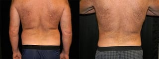 Before and after Liposuction case 32752 - Angle 1